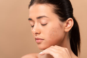 How Dealing with Acne Scars Can Improve Your Skin's Texture