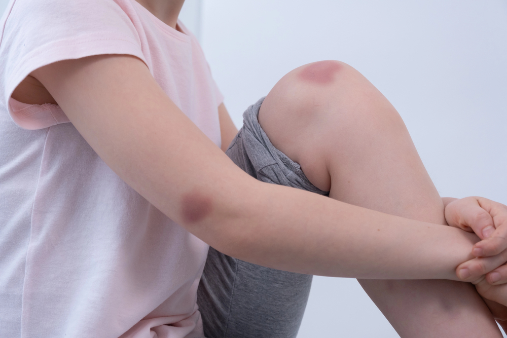 Bruising in Children: A Parent's Guide